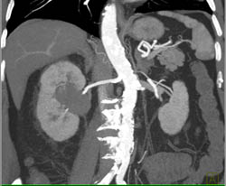 Cystic Renal Cell Carcinoma - CTisus CT Scan