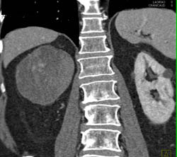 Cystic Renal Cell Carcinoma - CTisus CT Scan