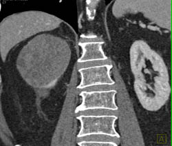 Cystic Renal Cell Carcinoma - CTisus CT Scan