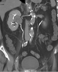 Transitional Cell Carcinoma - CTisus CT Scan