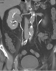 Transitional Cell Carcinoma - CTisus CT Scan