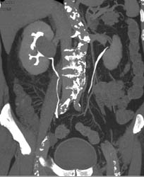 Transitional Cell Carcinoma - CTisus CT Scan