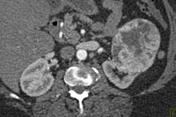 Renal Cell Carcinoma - CTisus CT Scan