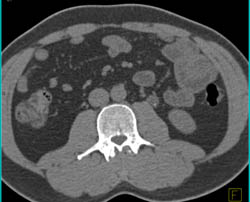 Obstruction of the Left Renal Pelvis and Ureter By Tumor - CTisus CT Scan
