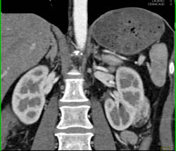 Renal Cell Carcinoma - CTisus CT Scan