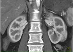 Renal Cell Carcinoma - CTisus CT Scan