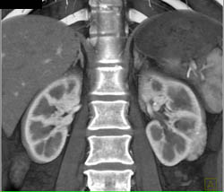 Renal Cell Carcinoma - CTisus CT Scan