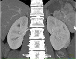 Renal Cell Carcinoma - CTisus CT Scan