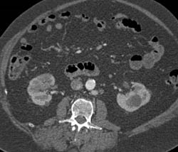 Transitional Cell Cancer (TCC) of Right Kidney - CTisus CT Scan