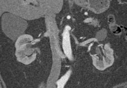 Transitional Cell Cancer (TCC) of Right Kidney - CTisus CT Scan