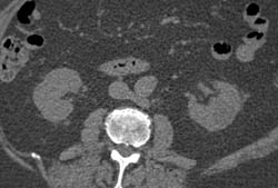 Transitional Cell Cancer (TCC) of Right Kidney - CTisus CT Scan