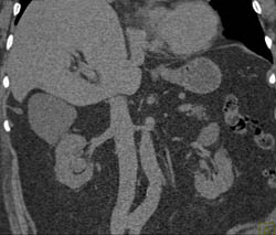 Transitional Cell Cancer (TCC) of Right Kidney - CTisus CT Scan