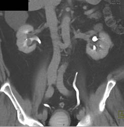 Transitional Cell Cancer (TCC) of Right Kidney - CTisus CT Scan