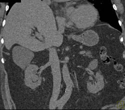 Transitional Cell Cancer (TCC) of Right Kidney - CTisus CT Scan