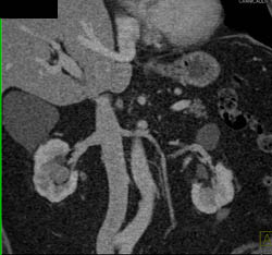 Transitional Cell Cancer (TCC) of Right Kidney - CTisus CT Scan