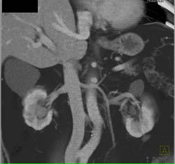 Transitional Cell Cancer (TCC) of Right Kidney - CTisus CT Scan