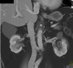 Transitional Cell Cancer (TCC) of Right Kidney - CTisus CT Scan