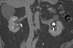 Transitional Cell Cancer (TCC) of Right Kidney - CTisus CT Scan