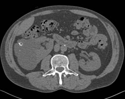 Complex Cyst With Calcification - CTisus CT Scan