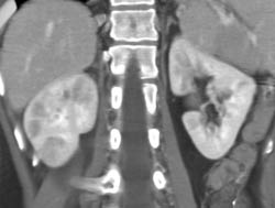 Acute Pyelonephritis - CTisus CT Scan