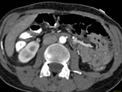 Acute Pyelonephritis - CTisus CT Scan