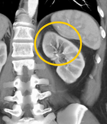 Acute Pyelonephritis - CTisus CT Scan