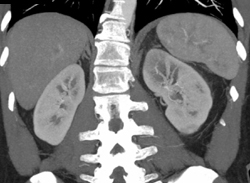 Acute Pyelonephritis - CTisus CT Scan