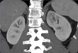 Acute Pyelonephritis - CTisus CT Scan