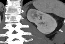 Acute Pyelonephritis - CTisus CT Scan