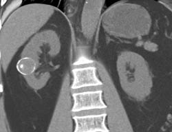 Calcified Renal Cyst - CTisus CT Scan