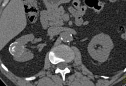 Calcified Renal Cyst - CTisus CT Scan