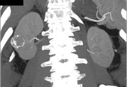 Calcified Renal Cyst - CTisus CT Scan