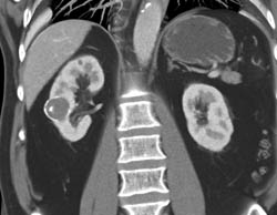 Calcified Renal Cyst - CTisus CT Scan