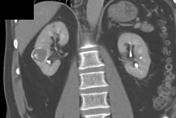 Calcified Renal Cyst - CTisus CT Scan