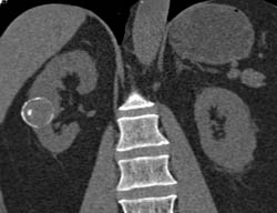 Calcified Renal Cyst - CTisus CT Scan