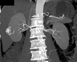 Calcified Renal Cyst - CTisus CT Scan