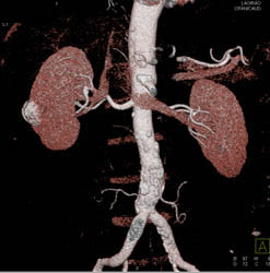 Calcified Renal Cyst - CTisus CT Scan