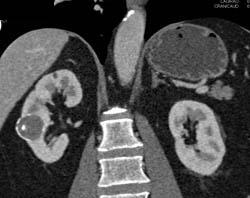 Calcified Renal Cyst - CTisus CT Scan