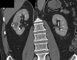 Calcified Renal Cyst - CTisus CT Scan