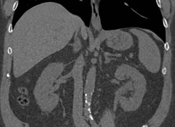 Duplicated Collecting System on the Right With Multiple Phases - CTisus CT Scan