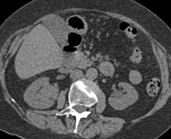 Multiple Phases of A Transitional Cell Carcinoma - CTisus CT Scan