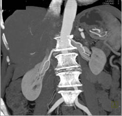 Normal Renal Arteries - CTisus CT Scan