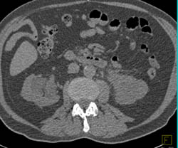 Form of Retroperitoneal Fibrosis Involves Both Renal Hila - CTisus CT Scan