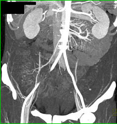 Tumor Infiltrates Left Psoas Muscle - CTisus CT Scan