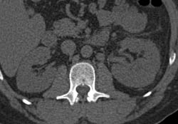 Multiple Phases of Acute Pyelonephritis Best Seen on Late Phase Images - CTisus CT Scan