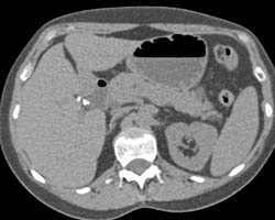 Atrophic Right Kidney - CTisus CT Scan