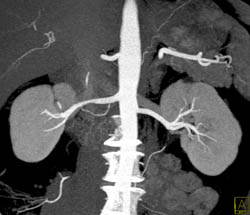 Normal Renal Arteries - CTisus CT Scan