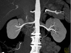 Normal Renal Arteries - Kidney Case Studies - CTisus CT Scanning