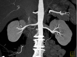 Normal Renal Arteries - CTisus CT Scan