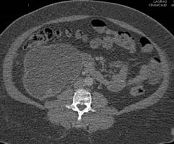 Obstructed Renal Transplant Simulates A Cystic Mass - CTisus CT Scan